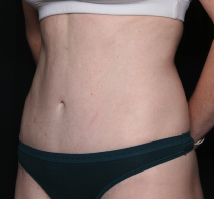 Liposuction Before & After Patient #35124