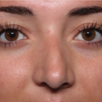 Rhinoplasty Before & After Patient #35270