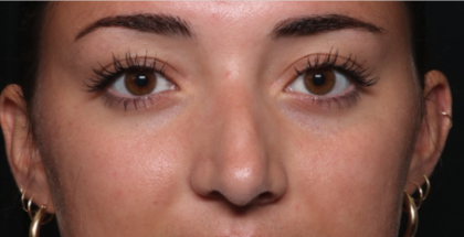 Rhinoplasty Before & After Patient #35270