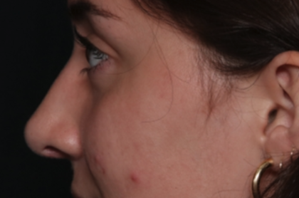 Rhinoplasty Before & After Patient #35270