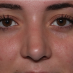 Rhinoplasty Before & After Patient #35270