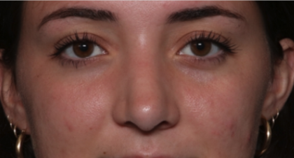 Rhinoplasty Before & After Patient #35270