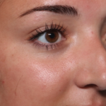 Rhinoplasty Before & After Patient #35270