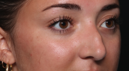 Rhinoplasty Before & After Patient #35270