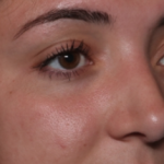 Rhinoplasty Before & After Patient #35270