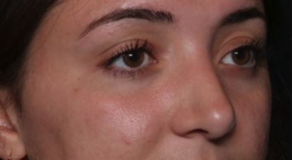 Rhinoplasty Before & After Patient #35270