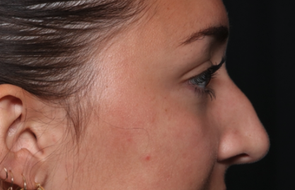 Rhinoplasty Before & After Patient #35270
