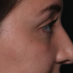Rhinoplasty Before & After Patient #35270