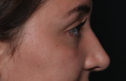 Rhinoplasty Before & After Patient #35270
