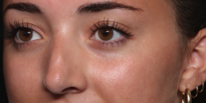 Rhinoplasty Before & After Patient #35270