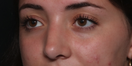 Rhinoplasty Before & After Patient #35270