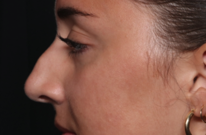 Rhinoplasty Before & After Patient #35270
