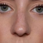 Rhinoplasty Before & After Patient #35299