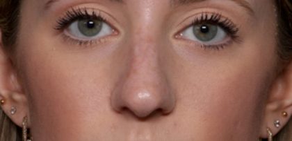 Rhinoplasty Before & After Patient #35299
