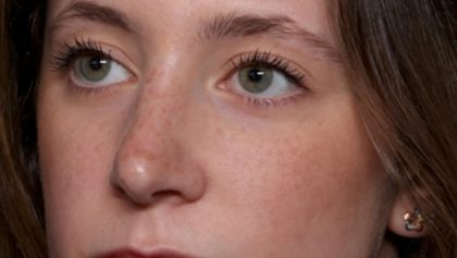 Rhinoplasty Before & After Patient #35299