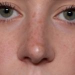 Rhinoplasty Before & After Patient #35299