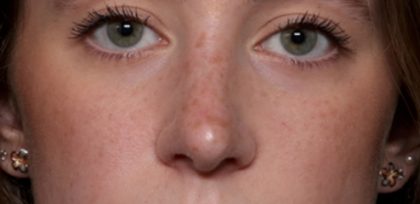 Rhinoplasty Before & After Patient #35299