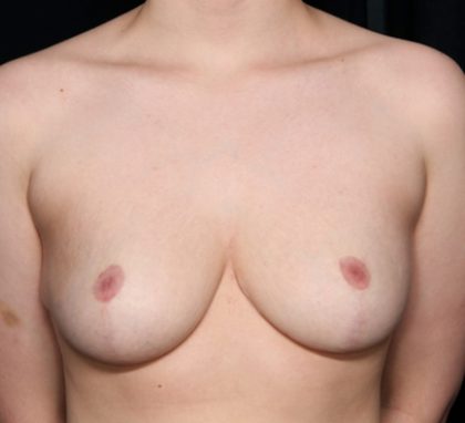 Breast Reduction Before & After Patient #35310