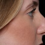 Rhinoplasty Before & After Patient #35299