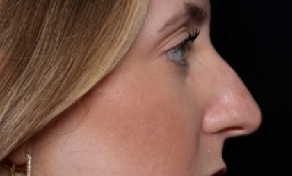 Rhinoplasty Before & After Patient #35299