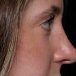 Rhinoplasty Before & After Patient #35299