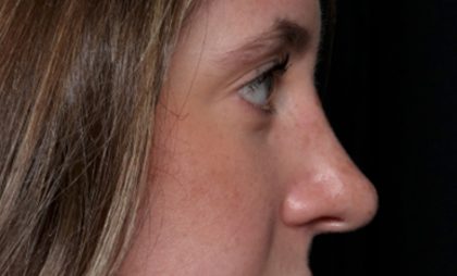 Rhinoplasty Before & After Patient #35299