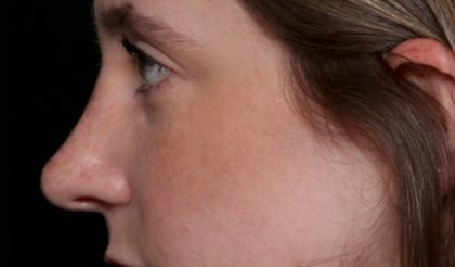 Rhinoplasty Before & After Patient #35299