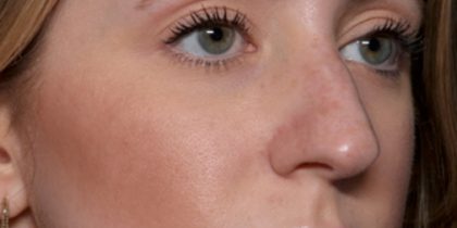 Rhinoplasty Before & After Patient #35299
