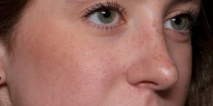 Rhinoplasty Before & After Patient #35299