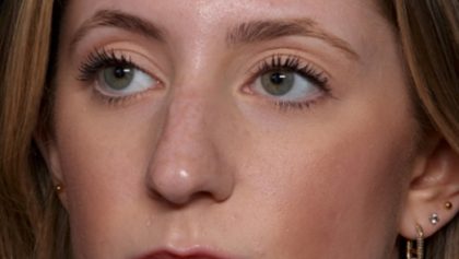 Rhinoplasty Before & After Patient #35299
