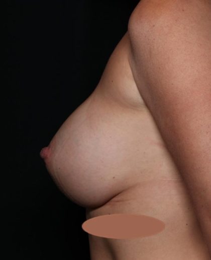 Breast Augmentation Before & After Patient #35348