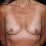 Breast Augmentation Before & After Patient #35413