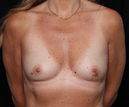 Breast Augmentation Before & After Patient #35413