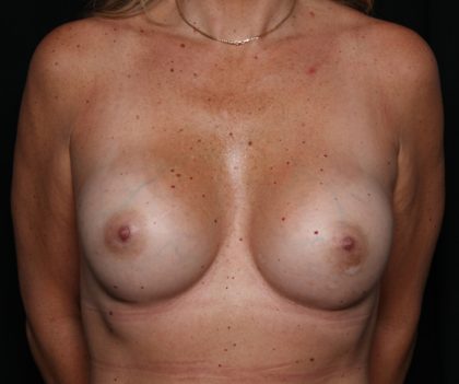 Breast Augmentation Before & After Patient #35413