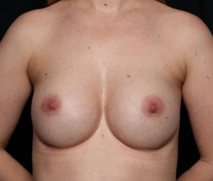 Breast Augmentation Before & After Patient #35337