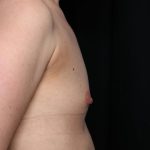Breast Augmentation Before & After Patient #35337
