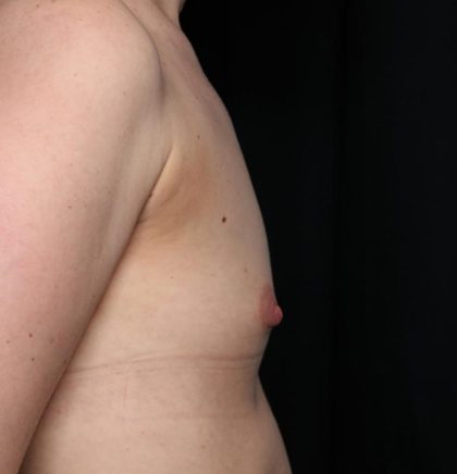 Breast Augmentation Before & After Patient #35337