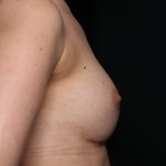 Breast Augmentation Before & After Patient #35337