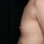 Breast Augmentation Before & After Patient #35337