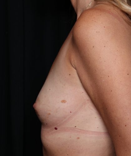 Breast Augmentation Before & After Patient #35413