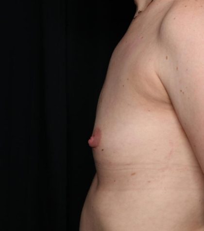 Breast Augmentation Before & After Patient #35337