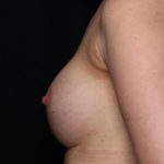 Breast Augmentation Before & After Patient #35337