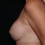 Breast Augmentation Before & After Patient #35413
