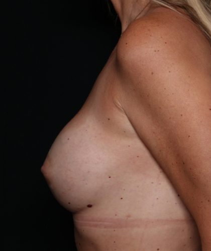 Breast Augmentation Before & After Patient #35413