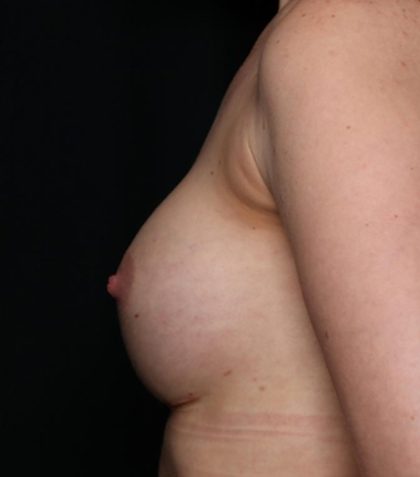 Breast Augmentation Before & After Patient #35337