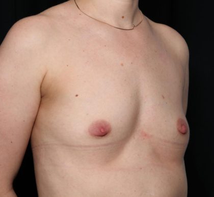 Breast Augmentation Before & After Patient #35337