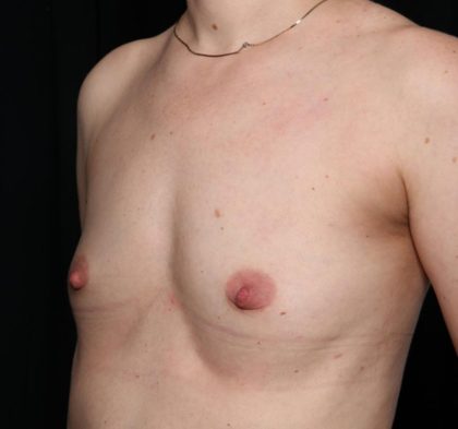 Breast Augmentation Before & After Patient #35337
