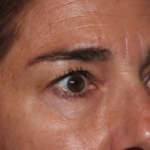 Blepharoplasty Before & After Patient #35585