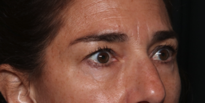 Blepharoplasty Before & After Patient #35585
