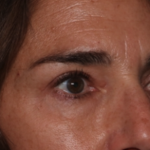 Blepharoplasty Before & After Patient #35585